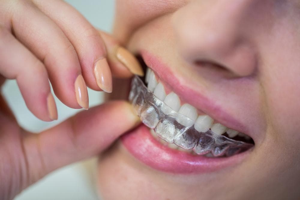 A young woman prepares to put on a clear dental aligner.