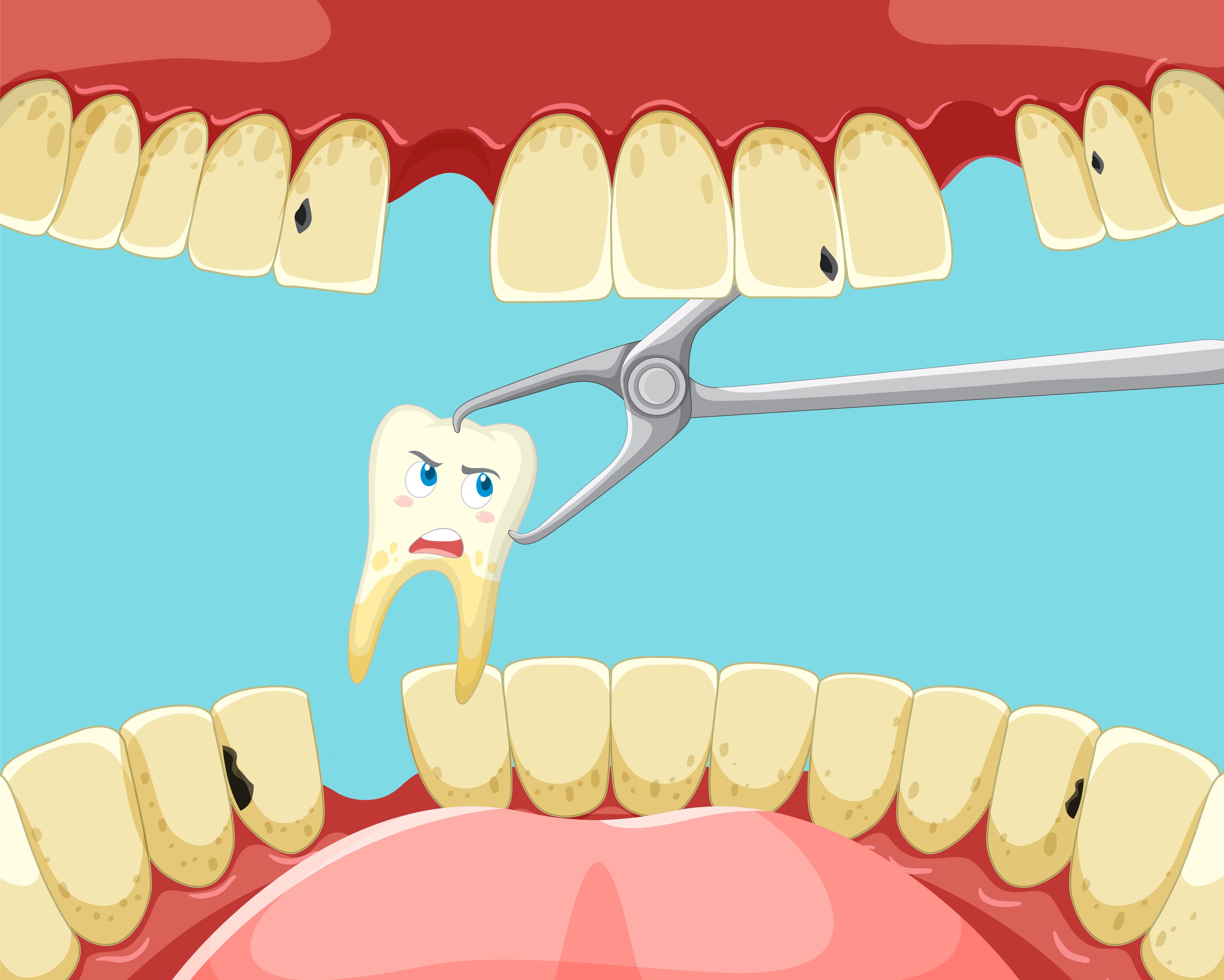Tooth extraction inside human mouth.