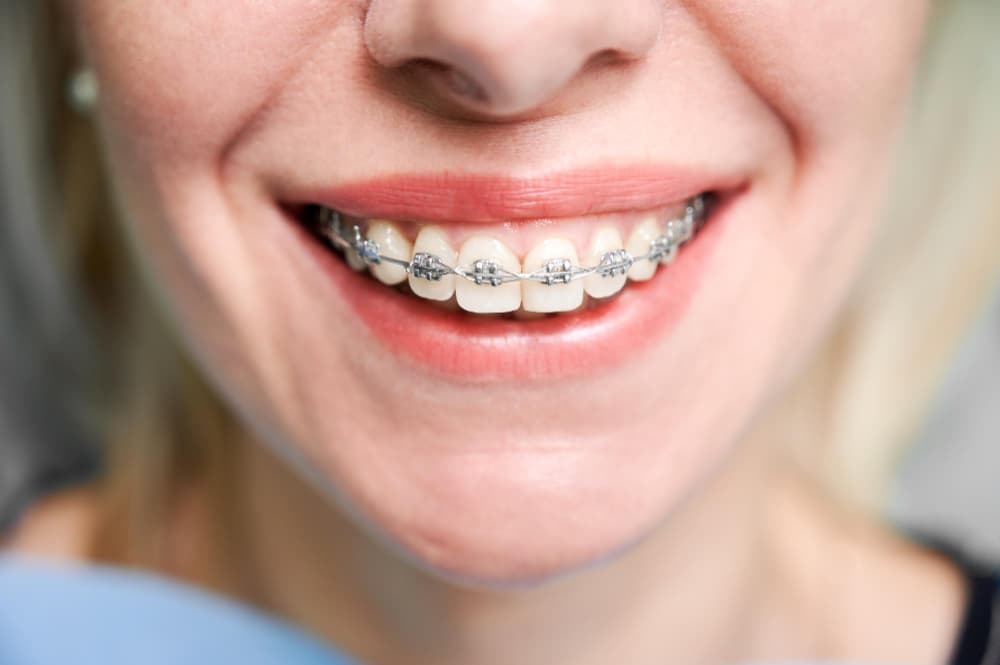 A close-up of a woman's teeth which have braces on them.