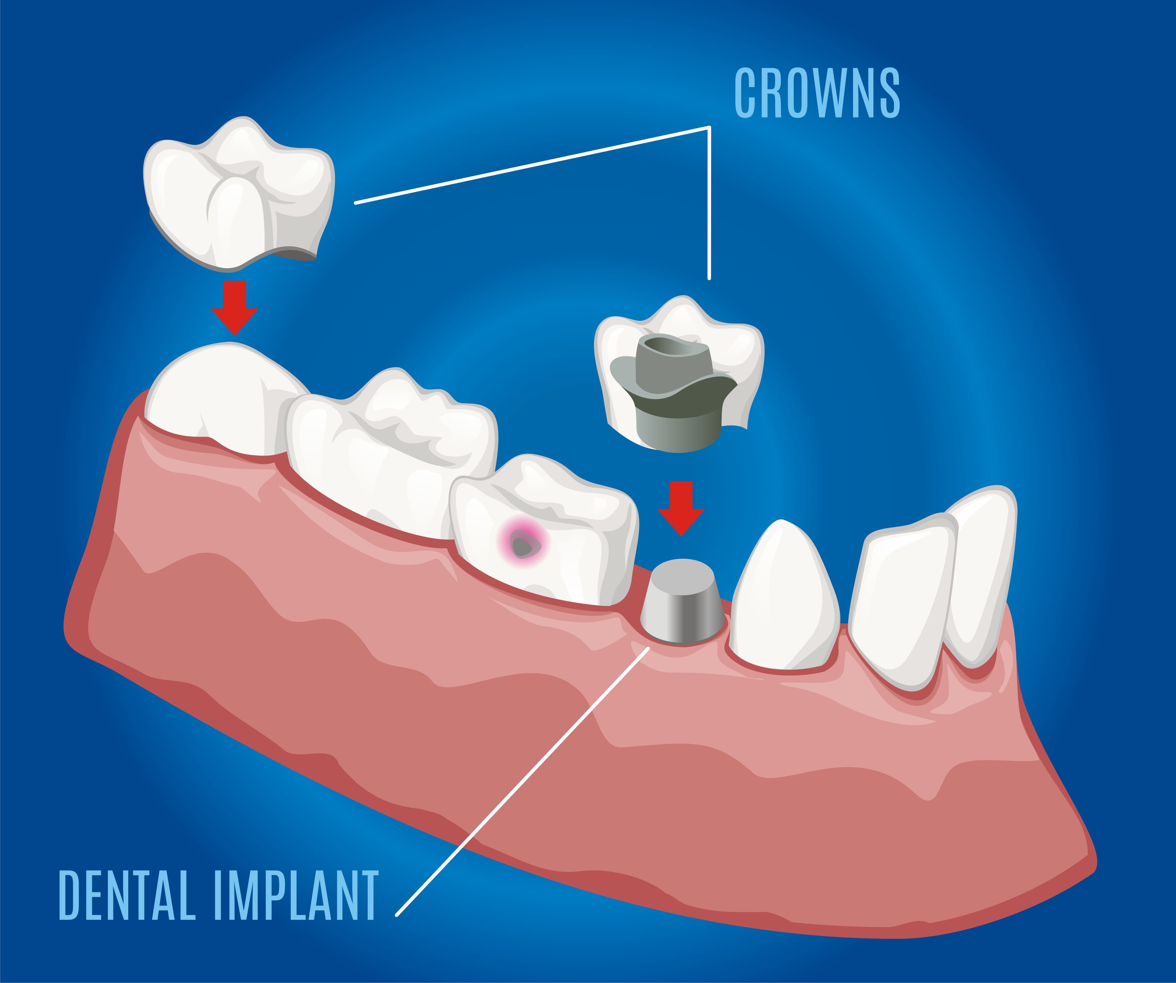 Isometric professional prosthetic stomatology template with dental implant and crowns on blue background.