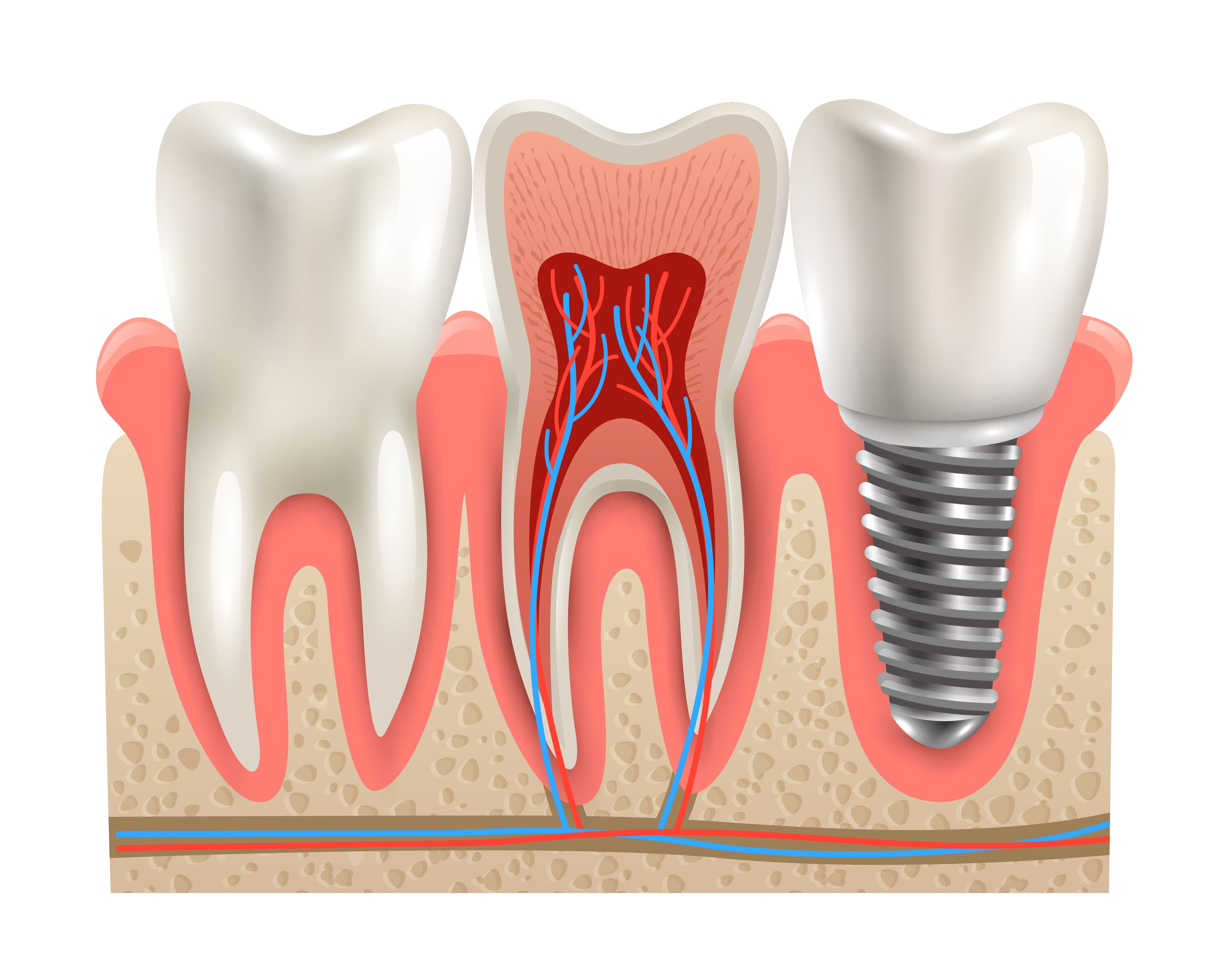 Dental implants anatomy closeup model.