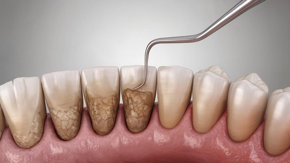Dental cleaning and scaling