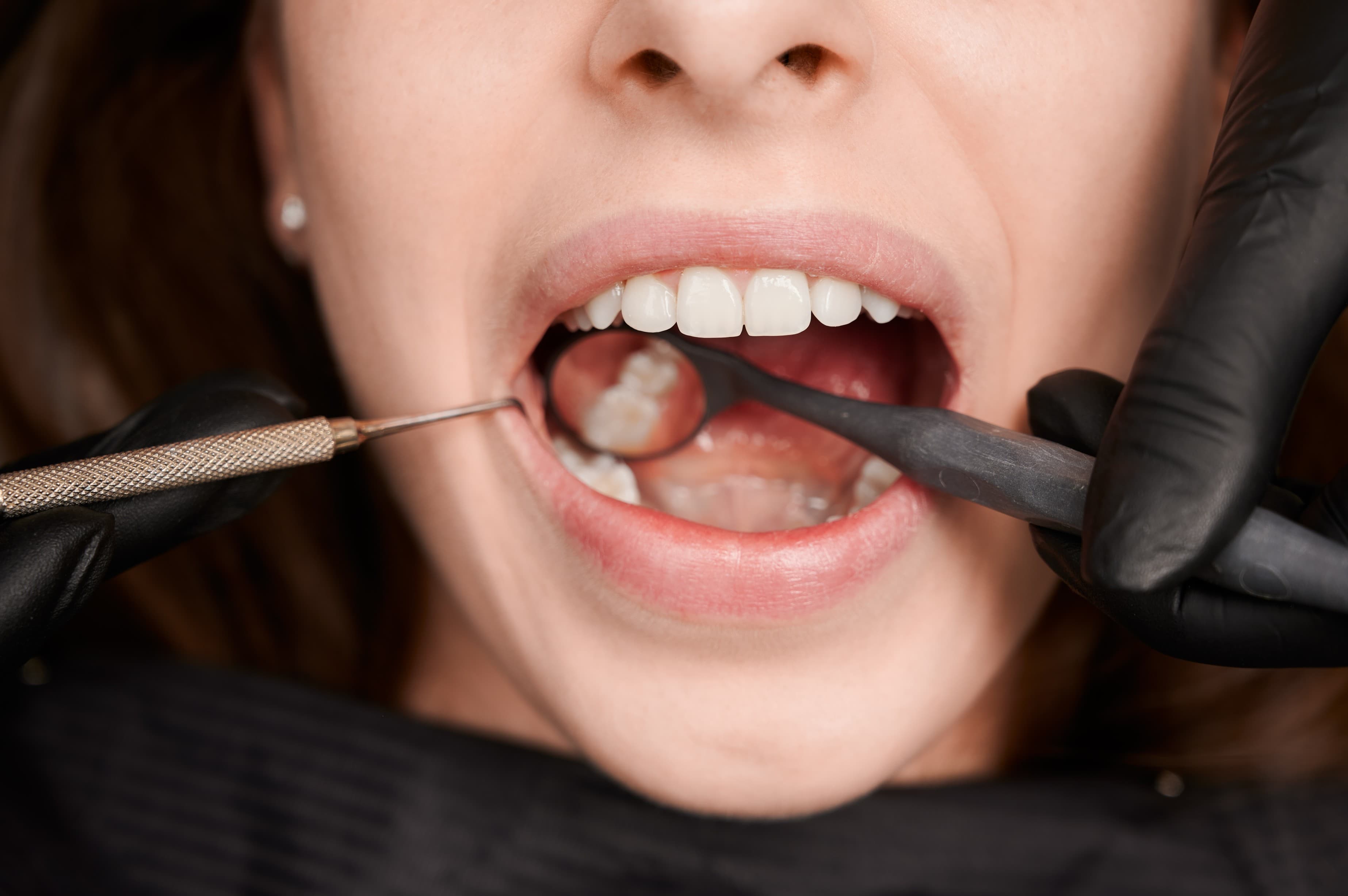 Wisdom Tooth Surgery in Noida — What Actually Happens Step by Step